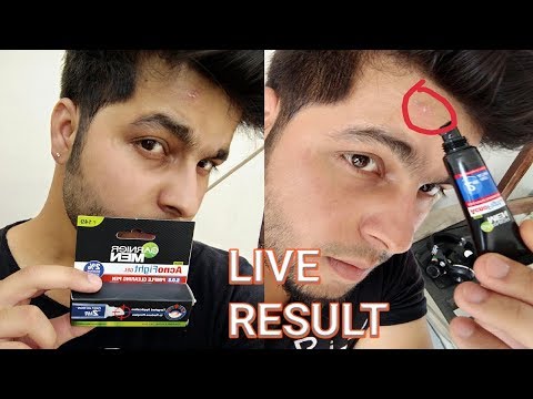 download lagu mp3 mp4 Garnier Pure Pimple Control Pen, download lagu Garnier Pure Pimple Control Pen gratis, unduh video klip Garnier Pure Pimple Control Pen