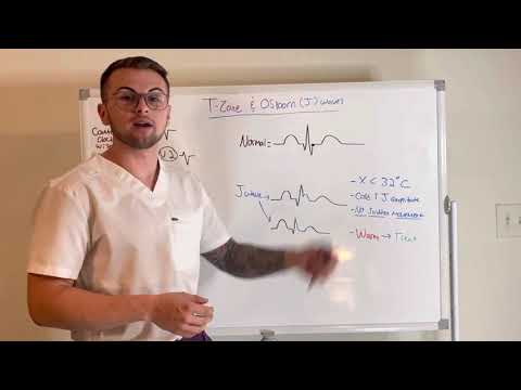 EKG Series: The Transition Zone and Osborn Waves (J-Waves)