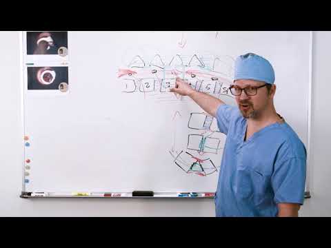 Pain Management | Post Operation | MIS-TLIF Transforaminal Lumbar Interbody Fusion