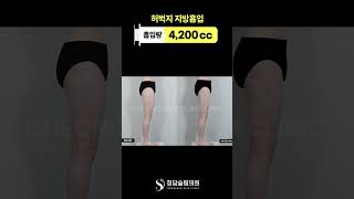 다이어트 종결, 허벅지 지방흡입🫶