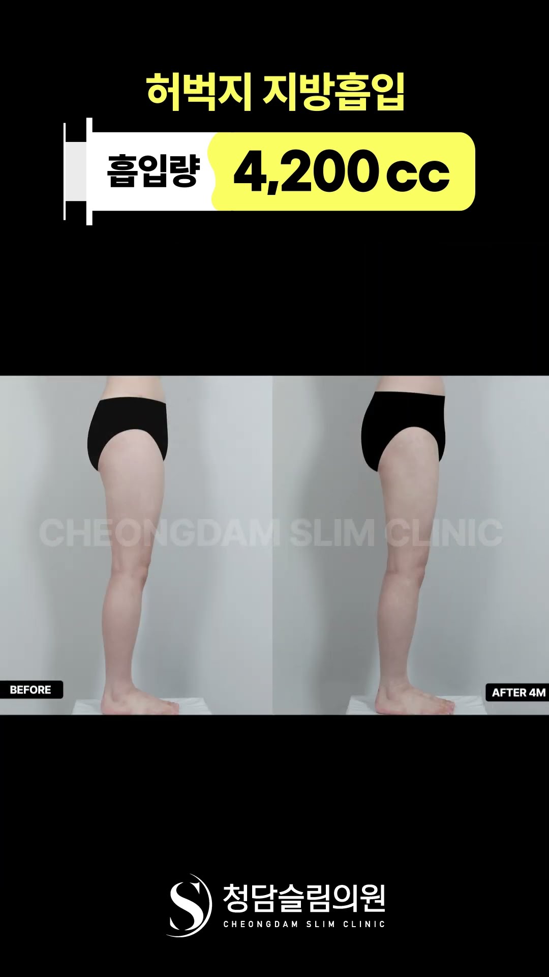 다이어트 종결, 허벅지 지방흡입🫶