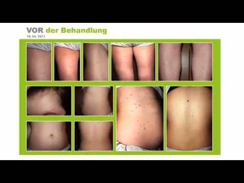 Chlorgeksidin von gribka der Nägel die Rezensionen Welche Merkmale bei gribke der Nägel