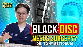 BLACK DISC: DO YOU REALLY NEED SURGERY | DR TONY SETIOBUDI