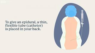 Labor Pain Relief Options: Epidurals and More | UCLA Health BirthPlace