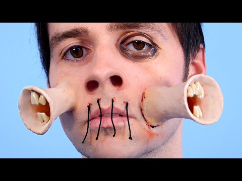 BOY GETS SIREN HEAD PLASTIC SURGERY!