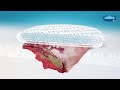 Wound Debridement with HydroClean | Medical Animation