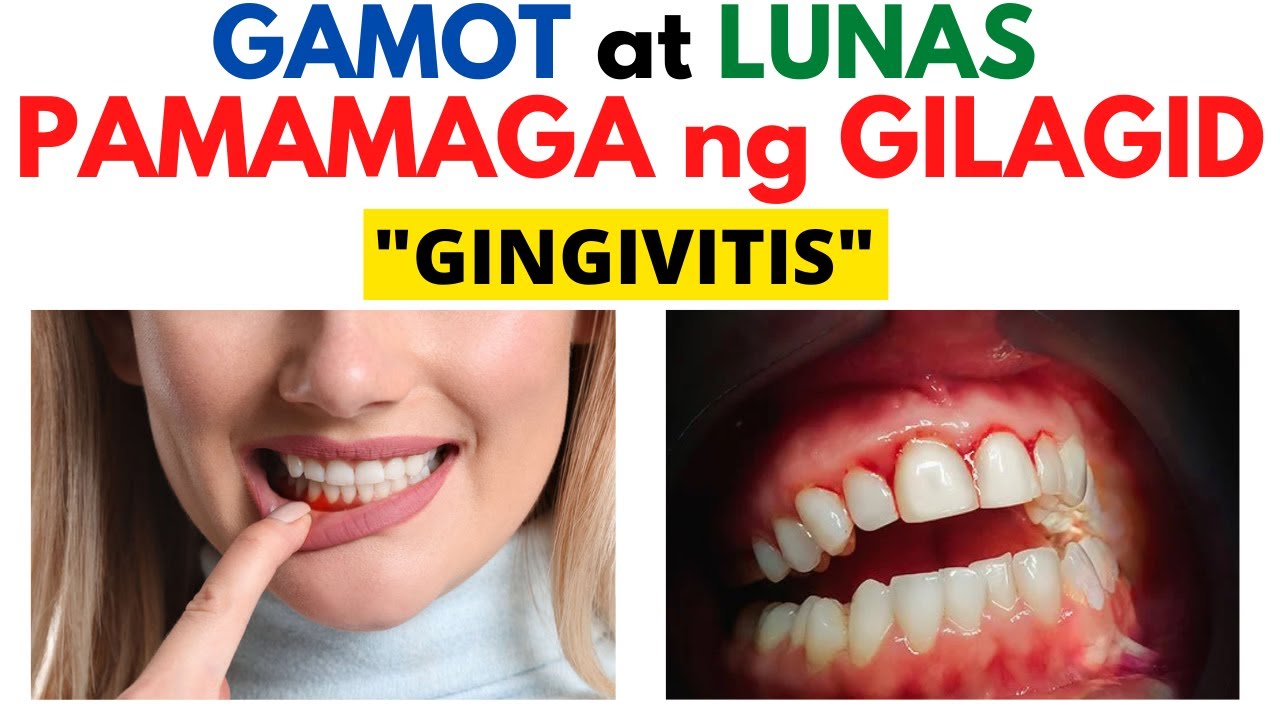 😦 Gamot sa Pamamaga ng GILAGID o GINGIVITIS + Mga SINTOMAS | Masakit at MAGA na GILAGID, BAGANG