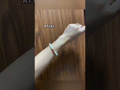 IV Whitening treatment video at DIVA Skin Clinic Poipet