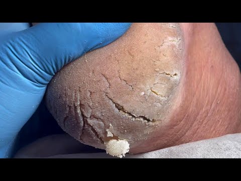 割腳