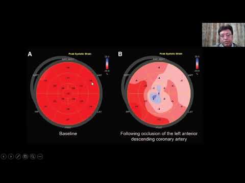 Peri-operative Assessment of Myocardial Deformation