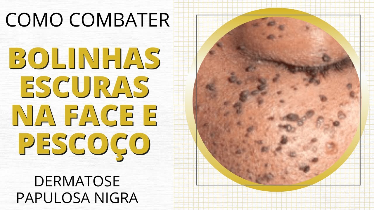 Como combater bolinhas escuras na face e pescoço (dermatose papulosa nigra)