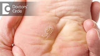 What causes of warts on hands and feet? - Dr. Urmila Nischal