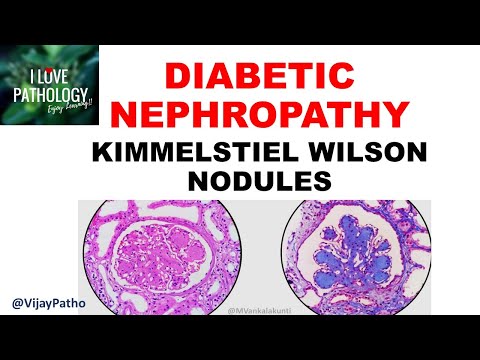 Kína kezelés 2-es típusú diabetes mellitus