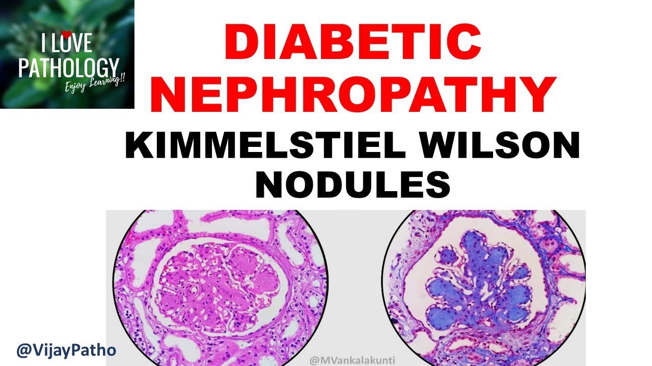 DIABETIC NEPHROPATHY :Pathophysiology & Morphology