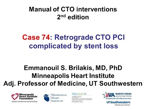 Case 74: Manual of CTO Interventions - Stent loss during retrograde CTO PCI