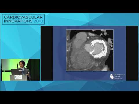 CVI2018 Session: Successful therapy of severe mitral annular calcification - Paul Sorajja, MD