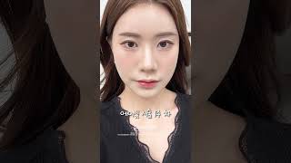 에이빛주사 후, 환해진 눈밑!