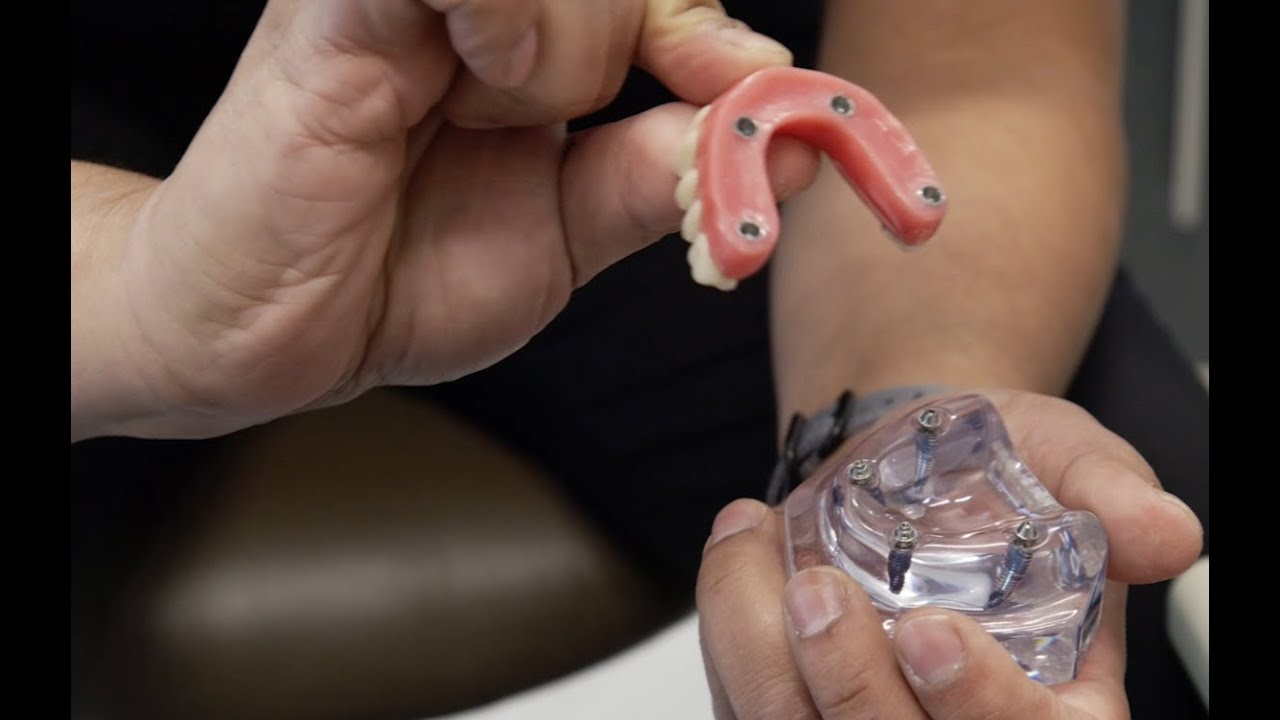 All-on-4 Dental Implants in Austin | Central Texas Periodontics