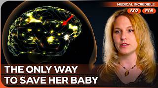 Doctors Removed Half Her Brain to Stop Her Seizures | Medical Incredible