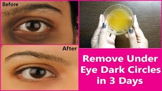 Remove Under Eye Dark Circles in 3 Days | 100% Effective Natural  Remedy for  Under Eye Dark Circles