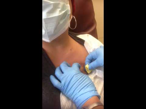 3rd Round of Adriamycin Cytoxan Chemo Through Chest Port