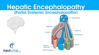 Hepatic Encephalopathy :(portal systemic encephalopathy) causes, classification, features,DX and rx