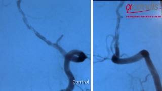 Stenosis Treatment - Acandis NeuroSpeed® Balloon Catheter & Credo® Stent