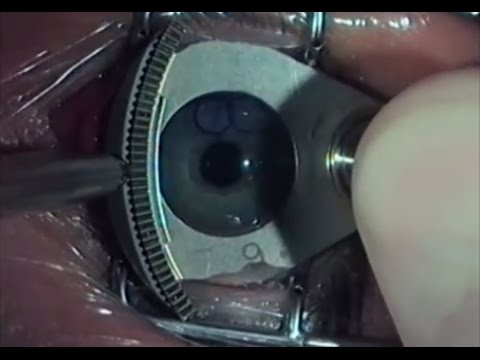 Augenlaseroperation | Nie wieder Brille oder Kontaktlinsen