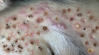 Loan Nguyen Acne Treatment 7m