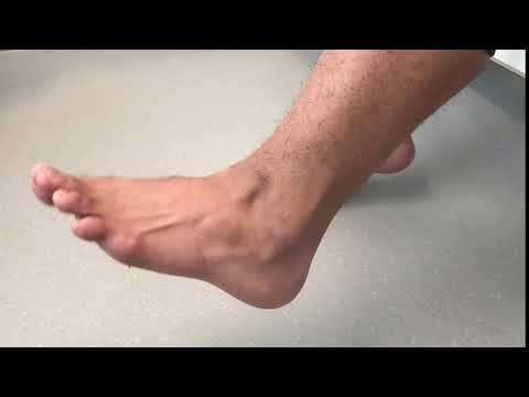 Peronealsehnen-Luxation