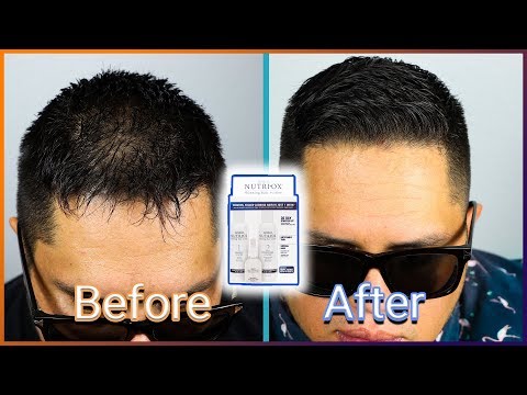 THINNING HAIR? BALDING? WATCH THIS! Nutri-Ox Product Review