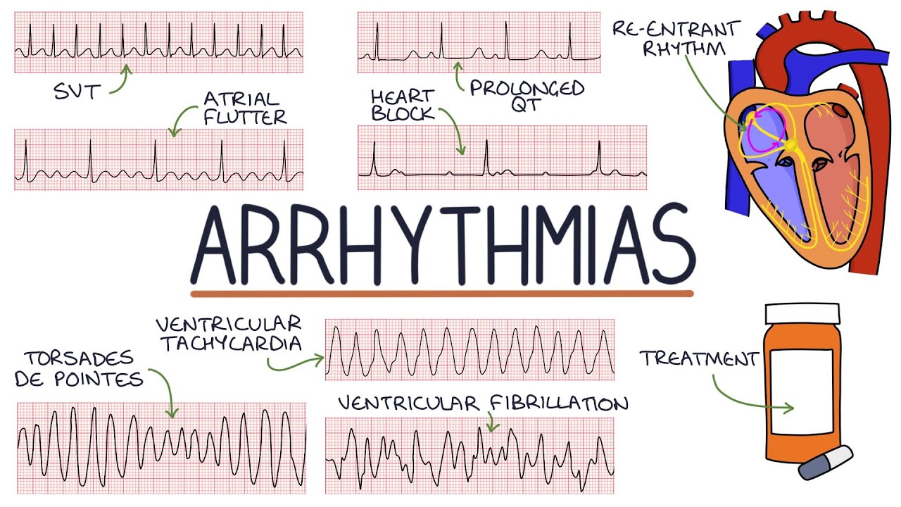 Understanding Arrhythmias