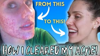 HOW I CLEARED MY ACNE ( Chronic, Cystic, Digestive, Hormonal)