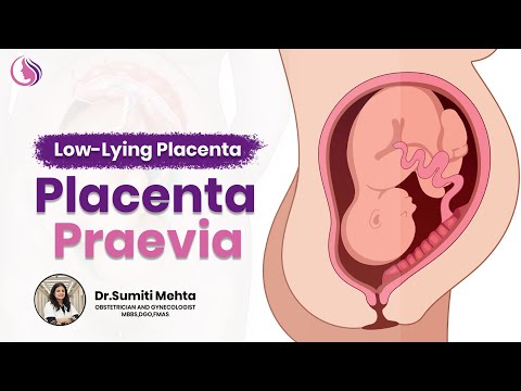  Low-Lying Placenta (Placenta Praevia): क्या है Risks?