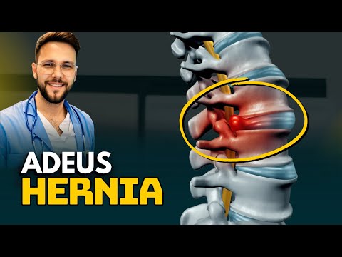 O Melhor Exercicio para DOR Ciatica e HERNIA DE DISCO - McKenzie