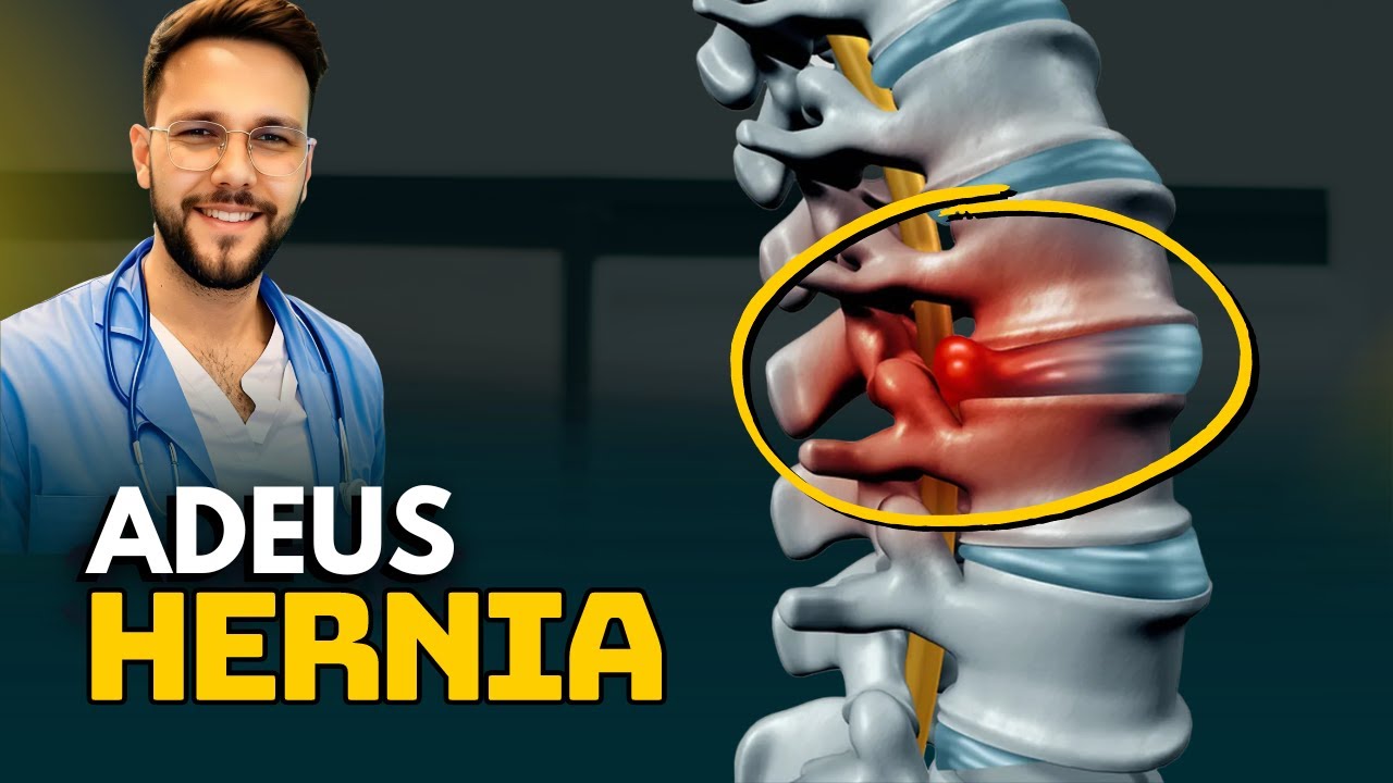 O Melhor Exercicio para DOR Ciatica e HERNIA DE DISCO - McKenzie