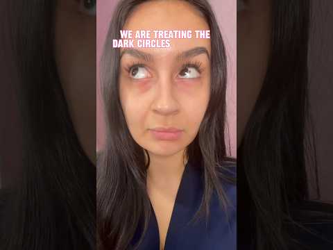 PRP gegen Augenringe – für strahlendere Augen