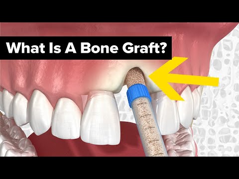 Dental Bone Grafts Explained