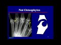 Imaging In Osteoarthritis