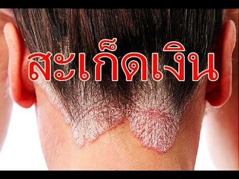 โรคสะเก็ดเงินรักษากลากหนังศีรษะ ในการรักษาโรคสะเก็ดเงิน aloem