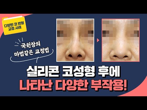[ 코 변형 쿄정 사례] 실리콘 코 성형 후에 나타난 다양한 부작용