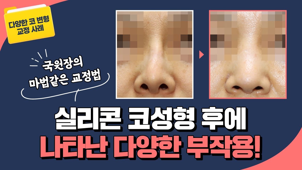 [ 코 변형 쿄정 사례] 실리콘 코 성형 후에 나타난 다양한 부작용 썸네일
