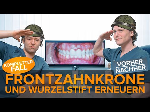 Frontzahnkronen + Wurzelstift nach ⚡ Fraktur ⚡ erneuern - Kompletter Fall inkl. vorher Nacher
