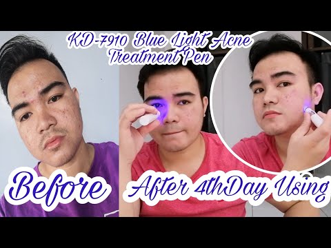 K-D 7910 BlueLight AcneTreatment Pen (updated) review