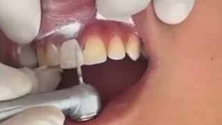 Central superior en resina Video N 53