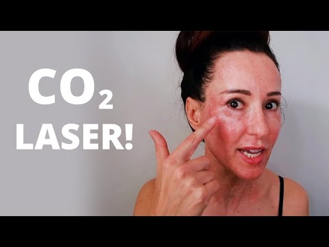 CO2 Fractional Ablative Laser: Before & After, Pain Levels, & Recovery! | Dr. Bartos Dermatology
