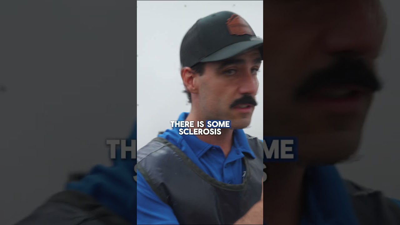 Tracking Bone Infection Healing with Repeat X-rays