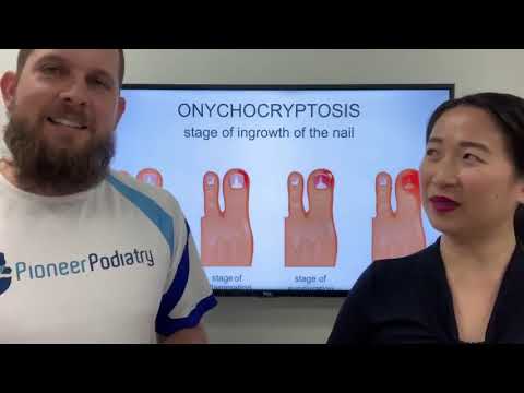 2nd YouTube video about are ingrown toenails genetic