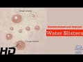 Water Blisters Unveiled: Causes, Treatment, and Prevention