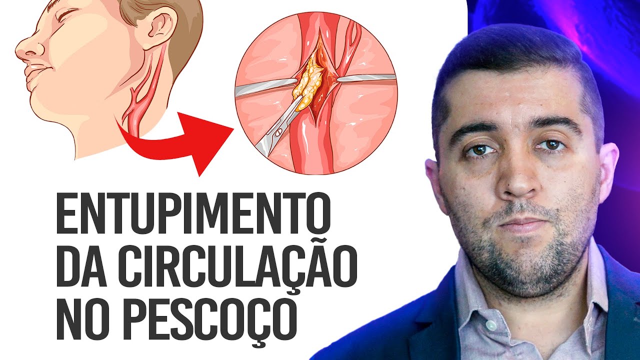 Qual risco da doença nas carótidas, as artérias que levam sangue para a cabeça e o pescoço?